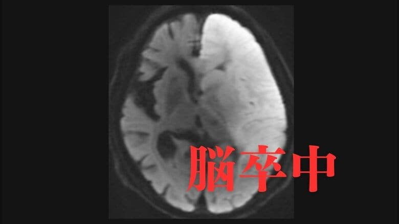 脳卒中は“発症から4時間半”がターニングポイント　早期治療につなげるための3つの初期症状と地域医療を支える情報共有システム｜FNNプライムオンライン