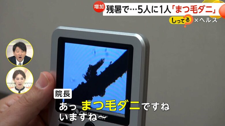 顕微鏡で見た、多くの人の目の痒みの原因になっているまつ毛ダニ