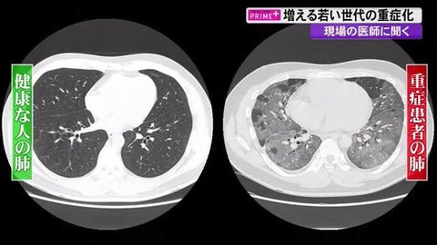 基礎疾患がなくても…若い世代の重症化が増加 コロナ治療にあたる医師「“うつぶせ”の姿勢で肺を守る」【高知発】