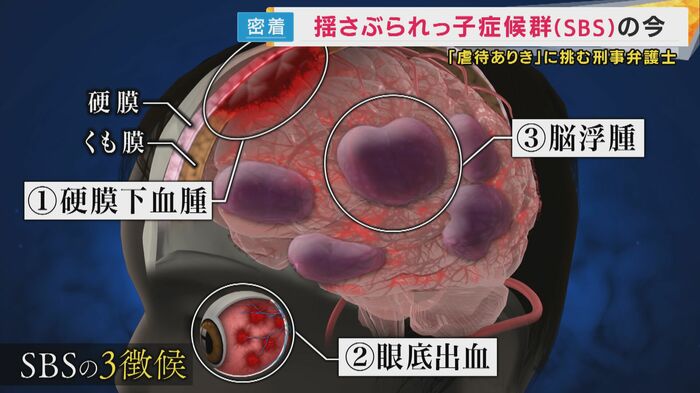 SBSの3徴候