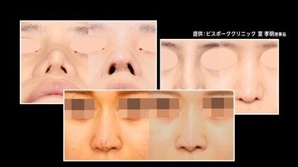 【急増】美容医療トラブルの背景に“直美”の存在…術後に鼻呼吸できなくなるケースも　ベテラン医師による教育スキーム“JIKIDEN”とは