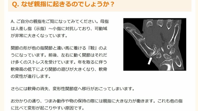 母指CM関節症の要因（田中医師の公式ウェブサイトより）