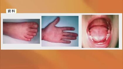 「手足口病」の患者数が警報値超え　乳幼児を中心に感染拡大、タオルの共用などに注意
