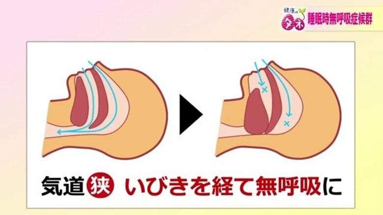 うつ病リスクが5倍「睡眠時無呼吸症候群」 “たかがいびき”と油断すると低酸素状態に 3つのサインを医師が解説|FNNプライムオンライン