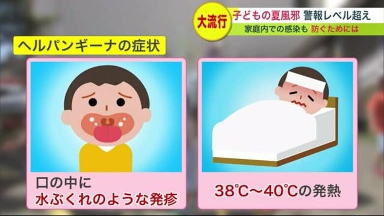 子どもの夏風邪が大流行 「ヘルパンギーナ」7年ぶり警報レベル…家庭内感染防ぐには？【北海道発】｜FNNプライムオンライン