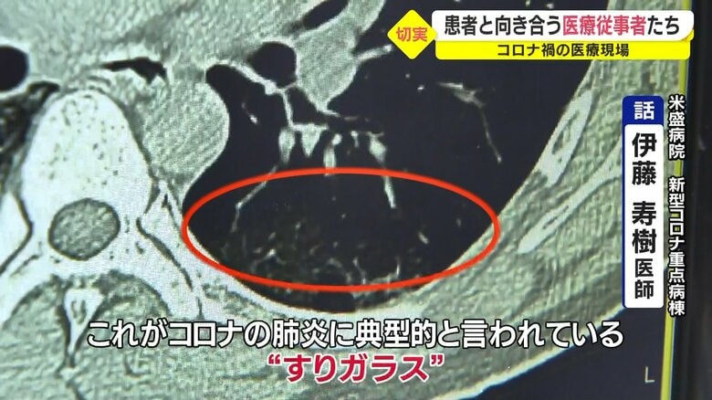 肺に“すりガラス”状の白い影が…