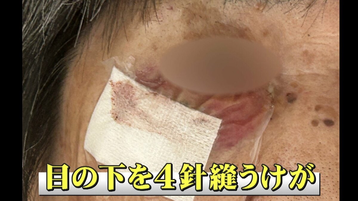 クマ外傷 恐怖】目の下を4針縫うケガ…被害女性（82）語るクマに襲われた瞬間