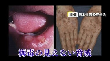 梅毒の見えない脅威“知らぬ間の感染”　「薬飲めば治るんでしょ？」若者の無知は性教育…