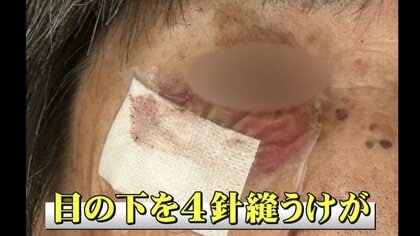 【恐怖】目の下を4針縫うケガ…被害女性（82）語るクマに襲われた瞬間「バーッと来て顔を…」 顔・頭を狙うクマ 命を守るためにできること