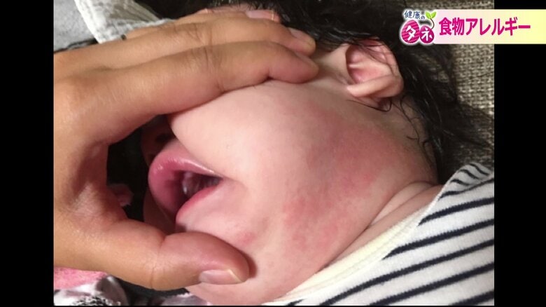 子どもの食物アレルギー20年で20万人増加　“正しい時期の離乳食で抗体を”さらに…「スキンケア」で予防｜FNNプライムオンライン