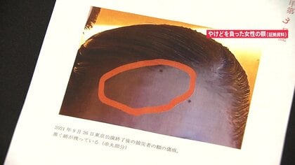 【宝塚問題】亡くなった劇団員の遺族側が“LINE”と“やけど写真”公開…5年前にも“パワハラ隠蔽”か？親族訴え「5年前と変わらない」