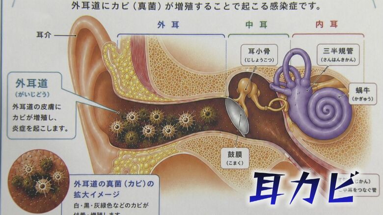 耳のトンネル部分にカビが生える“耳カビ”