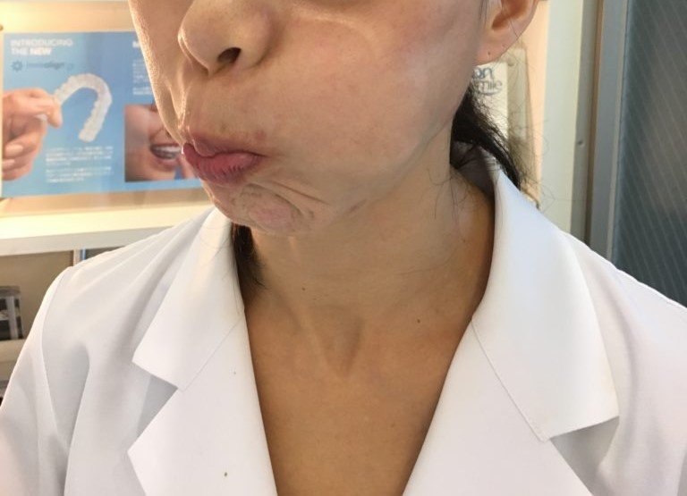 ほうれい線を予防するトレーニング（提供：アンチエイジングデンタルクリニック恵比寿）