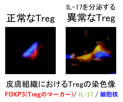 免疫系細胞の異常が皮膚の老化を促進する新たなメカニズムを解明～制御性T細胞（Treg）の異常が老化細胞の蓄積を促進させる～