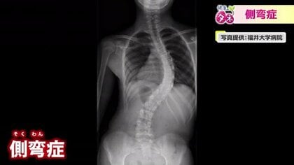 「手術するなら10代で」背骨が曲がる“原因不明”の側弯症　成長期の女子は特に注意　セルフチェックで早期治療を　