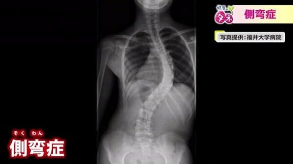 手術するなら10代で」背骨が曲がる“原因不明”の側弯症 成長期の女子は