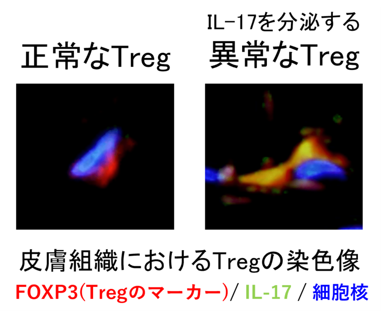 免疫系細胞の異常が皮膚の老化を促進する新たなメカニズムを解明～制御性T細胞（Treg）の異常が老化細胞の蓄積を促進させる～