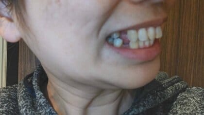 「歯科矯正の宣伝すれば実質無料」報酬支払われず健康被害も…患者ら新たに159人提訴　損害賠償請求4億5900万円