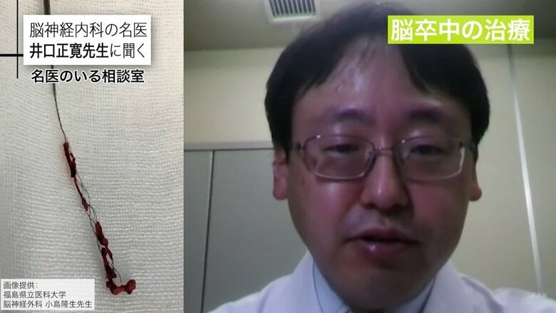 カテーテルで回収した血栓