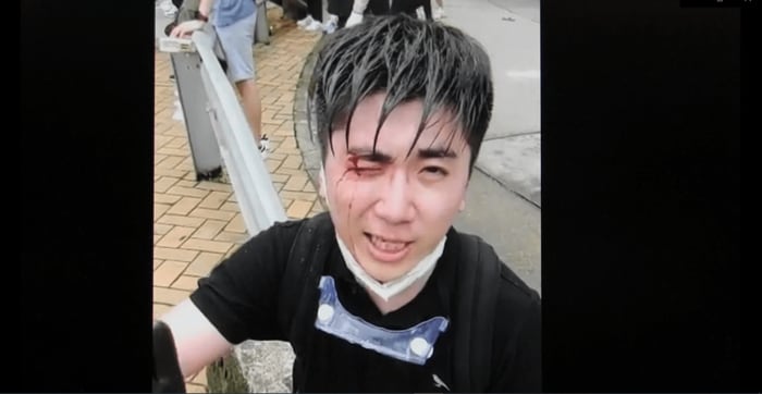 楊子俊さんは政府本部前のデモに参加し催涙弾を右目に被弾した(2019年6月)