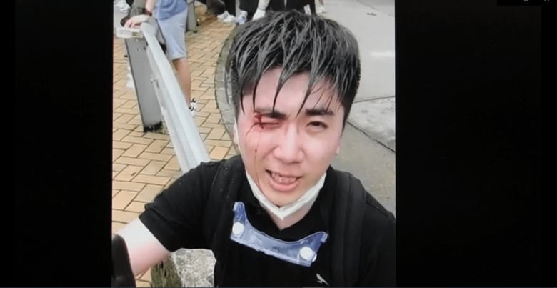 楊子俊さんは政府本部前のデモに参加し催涙弾を右目に被弾した(2019年6月)