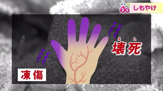 “凍傷”は指先の壊死に注意