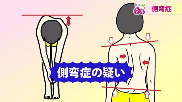 側弯症のチェック方法
