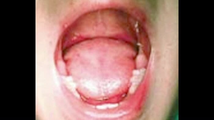 特に注意が必要なのが、口の中にできる発疹(提供:国立感染症研究所)