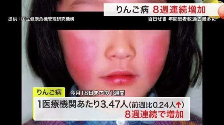 伝染性紅斑「りんご病」 宮城県内で８週連続増加　百日咳は年間患者数で過去最多に｜FNNプライムオンライン