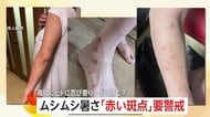 「赤い斑点」に要警戒！ホテルや旅館でトコジラミ被害か？夜間に忍び寄り100カ所以上「眠れないほどのかゆみ長く続く」一体どう防ぐ？