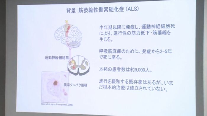 難病「ALS」の説明資料
