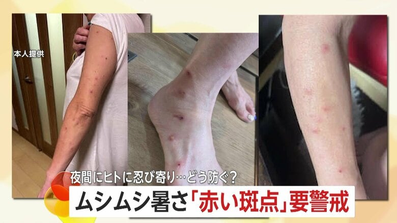 「赤い斑点」に要警戒！ホテルや旅館でトコジラミ被害か？夜間に忍び寄り100カ所以上「眠れないほどのかゆみ長く続く」一体どう防ぐ？｜FNNプライムオンライン