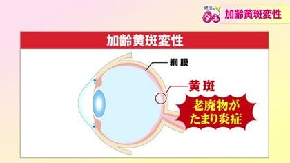 50歳以上は要注意「加齢黄斑変性」　視野がゆがむ、目がかすむ人は早めの受診を　1、2年で急激に進行も