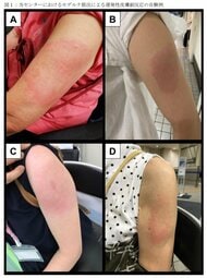 約18人に1人に「モデルナアーム」の症状…そのうち女性が83％となぜ多い? 調査した自衛隊中央病院に聞いた