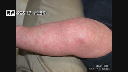 強い感染力「はしか」　医師「新幹線車両に1人いれば全員に」重症化、死亡する例も　妊婦は注意　ワクチン未接種の世代も