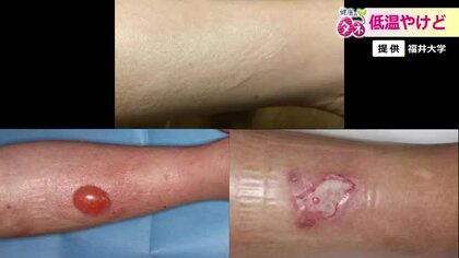 放っておくと手術が必要なほど悪化も…寒い冬には注意が必要「低温やけど」　予防と対応策を専門医に聞く