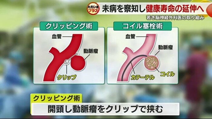 クリッピング術とコイル塞栓術について