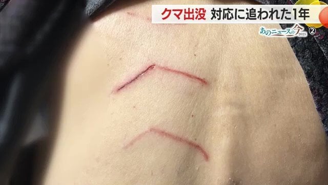 背中に残った痛々しいつめ跡を見せてくれた被害者