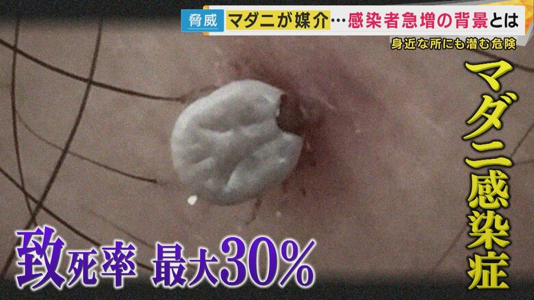 “致死率最大30％”『マダニ感染症』急増　奈良のシカや遊具ある公園にも「里山消失」で人住む場所に出没｜FNNプライムオンライン