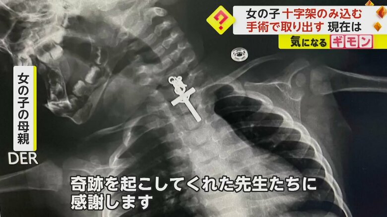 十字架を飲み込んだ女の子のエックス線写真