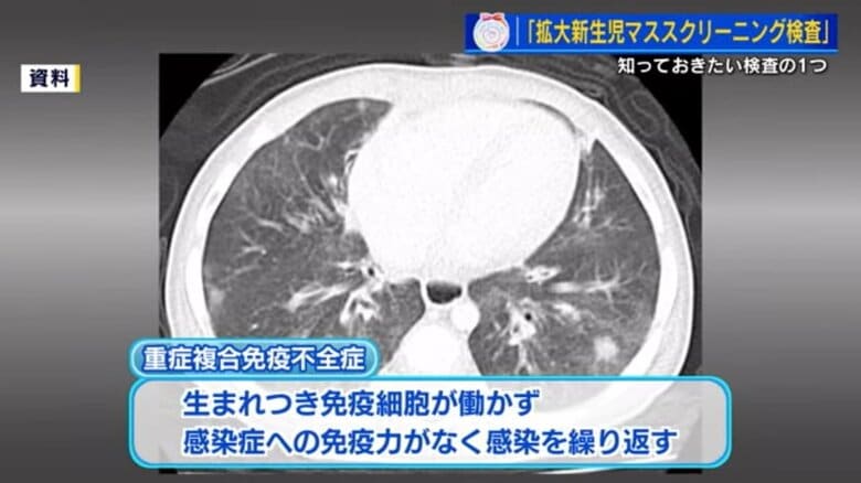 重症複合免疫不全症患者のCT画像