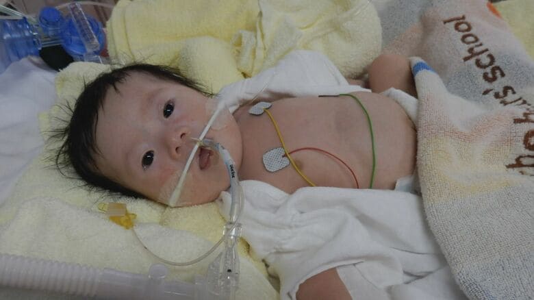 生後1ヵ月でダウン症と診断