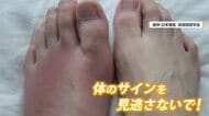 風が吹いただけでも痛いと言われる「痛風」　実は暑い時期に発症の危険性大　“足の指がむずむずする”は危険なサイン「受診を」