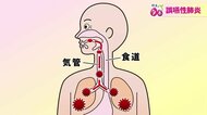 高齢者肺炎の7割を占める誤嚥性肺炎　パタカラ体操で“食べる力”を強化　早期発見は周囲の“気付き”がポイントに