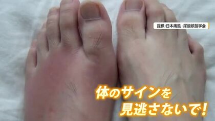 風が吹いただけでも痛いと言われる「痛風」　実は暑い時期に発症の危険性大　“足の指がむずむずする”は危険なサイン「受診を」