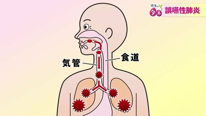 高齢者肺炎の7割を占める誤嚥性肺炎　パタカラ体操で“食べる力”を強化　早期発見は周囲の“気付き”がポイントに