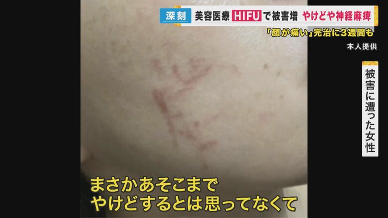 まさかやけどをするとは思ってなかった