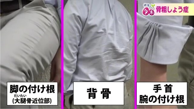骨粗しょう症で骨折しやすい部位