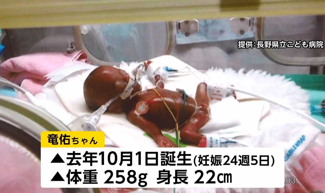世界最小 手のひらサイズ258ｇで生まれた男の子 元気に退院へ