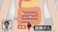 中村ゆりさんが患った直腸がんとは　若年患者は年間3000人超　「痔だと思っていたら…」血便・便秘など初期症状に注意